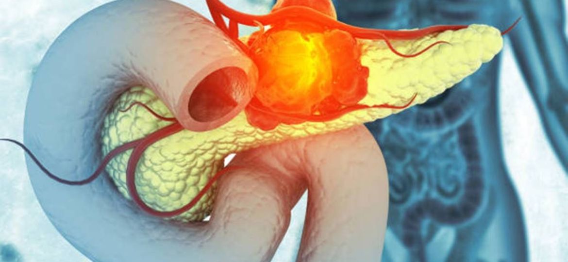 FDA-aprueba-Rasonque-nuevo-tratamiento-dirigido-para-el-cancer-de-pancreas-metastasico
